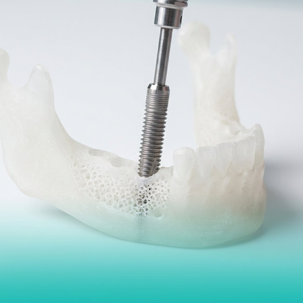 Implante dentário de titânio posicionado em modelo de mandíbula