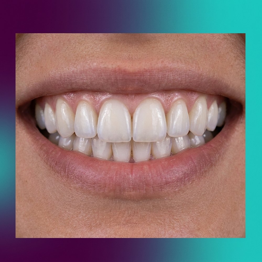 Lentes de contato dental em porcelana sobre modelo de sorriso